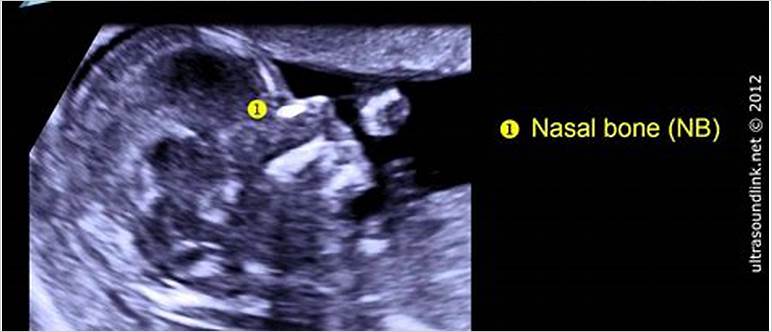 Down syndrome sonogram pictures